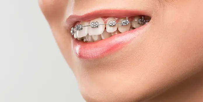 dental braces in chennai